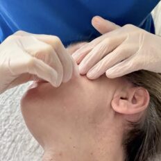 Transbuccal Massage